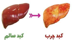 چرا کبد چرب می شود؟