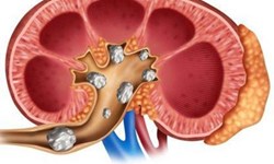 این دو ماده غذایی رو نخورید تا سنگ کلیه نگیرید