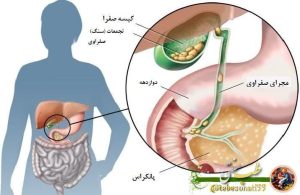 با سیب سنگ صفرا درمان کنید